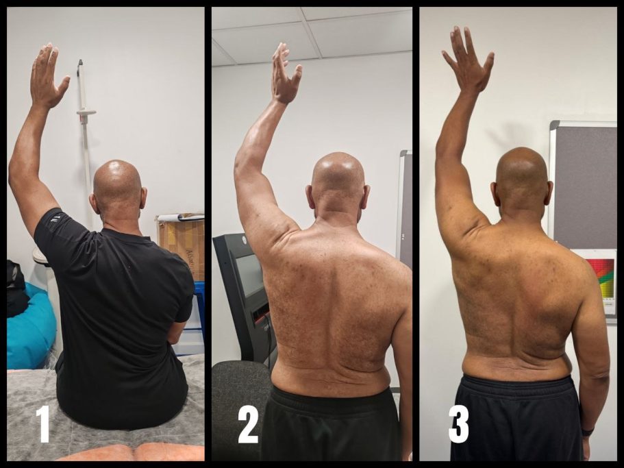 client's shoulder mobility rpogression a male's shoulder mobility progressive image showing a significant improvement in left shoulder's overhead reach and flexion